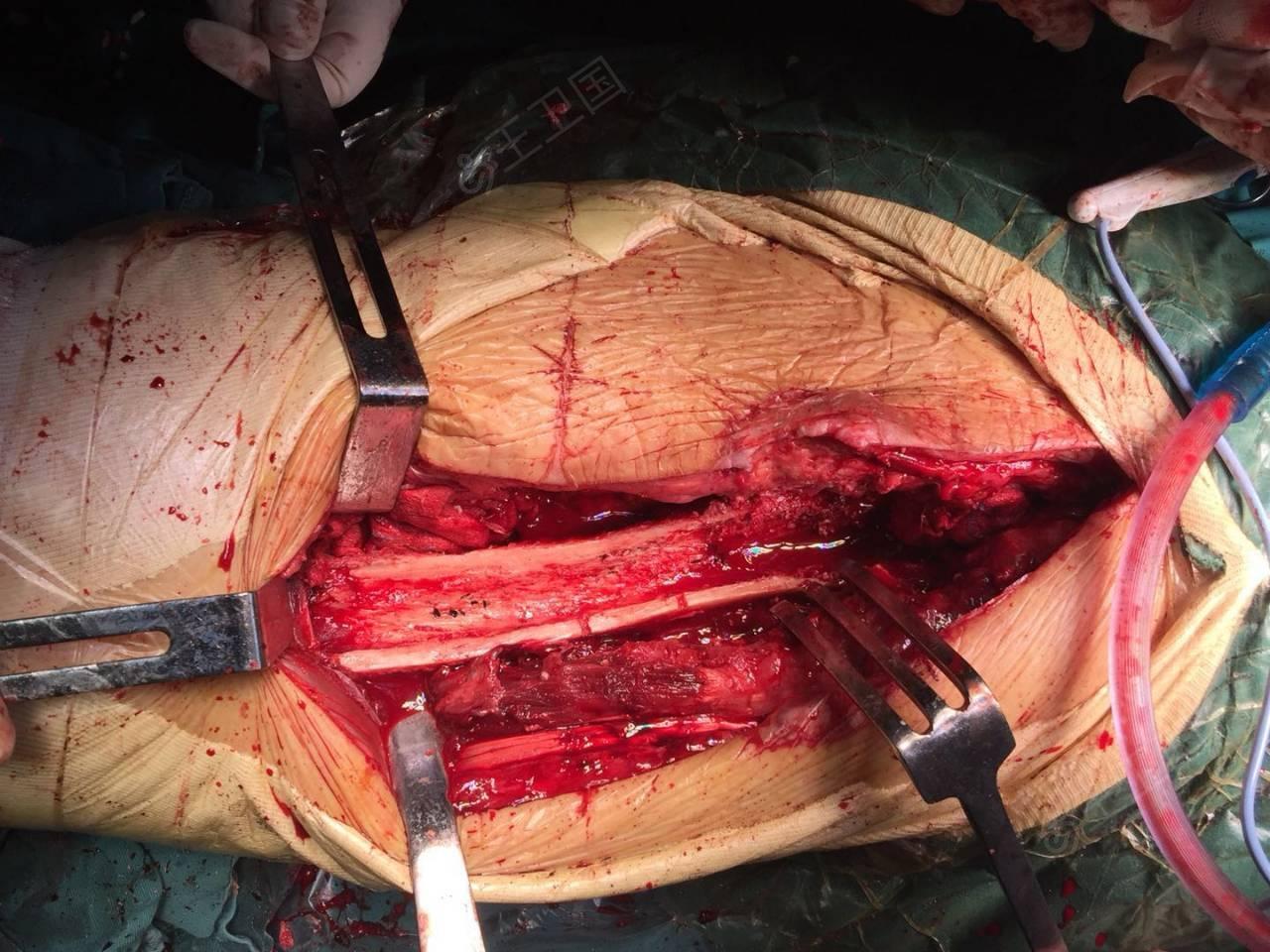 髋关节翻修超声骨刀取残留骨水泥