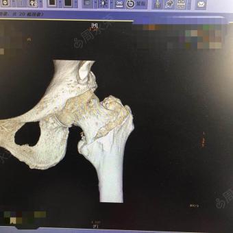股骨颈基底部骨折图片图片
