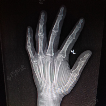左手环指近节指间关节骨折脱位