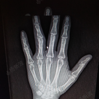 左手环指近节指间关节骨折脱位