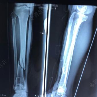 小腿骨裂图片 x光图片