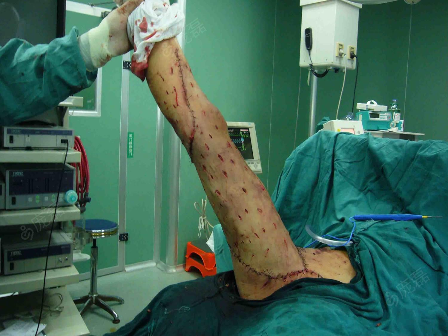 sealing drainage)负压引流术 手术记录 1,清创,反植皮联合vsd(vacuum