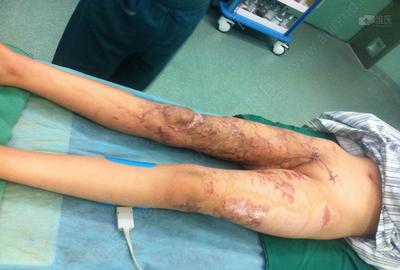 反植皮联合vsd技术治疗下肢大面积撕脱伤一例