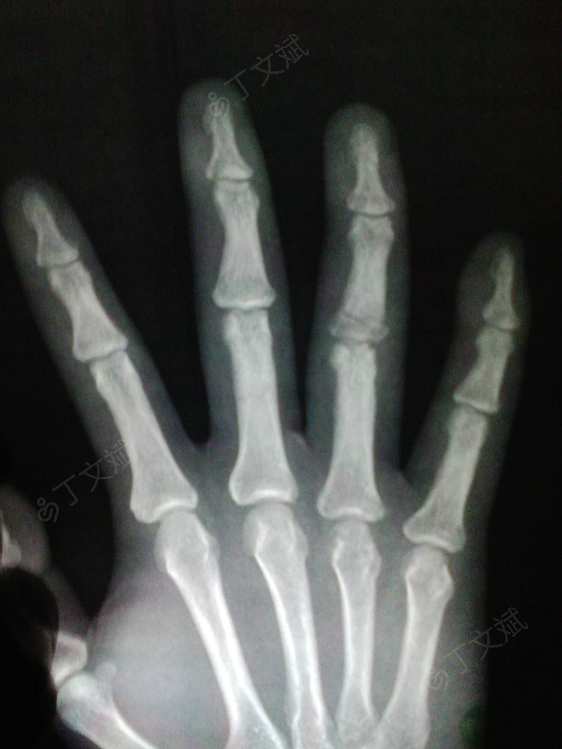 手指骨裂的症状图片