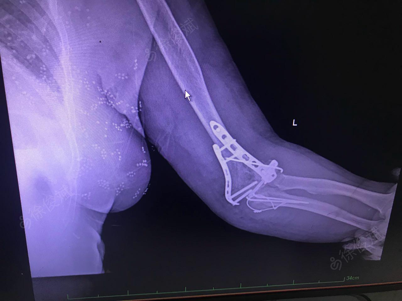 左肱骨髁上粉碎性骨折