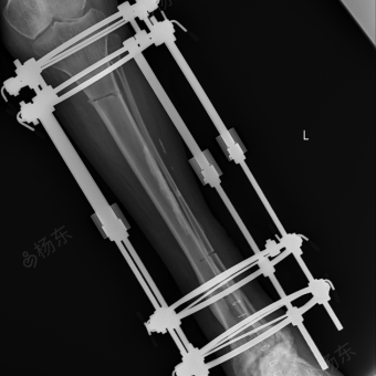 骨延长术治疗肢体短缩