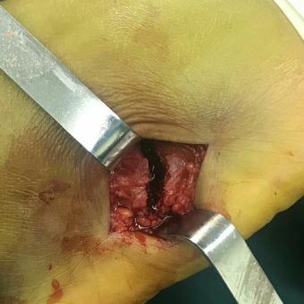 右足第五跖骨基底部骨折