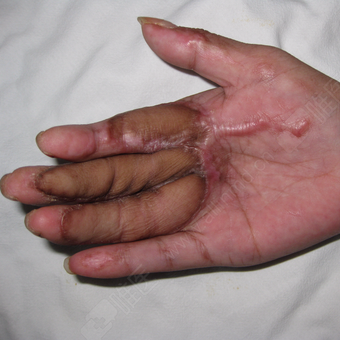 三叶皮瓣修复三个手指皮肤软组织缺损