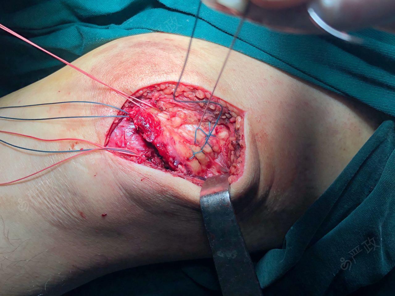 双侧股四头肌腱断裂缝合术