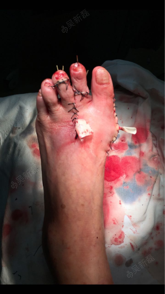 平板测试,拇趾末节趾腹下容1指,2,3跖趾关节处切口,暴露关节,weil截骨