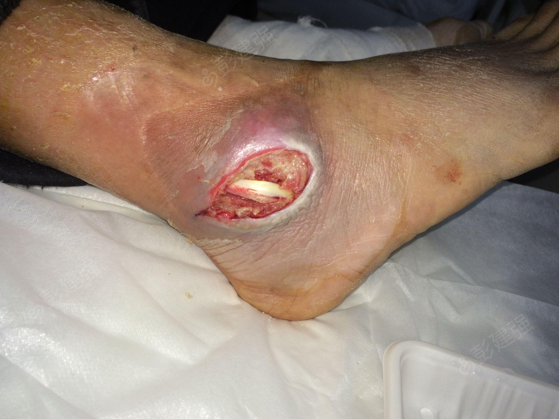65岁糖尿病患者 外踝软组织感染坏死修复
