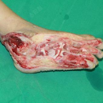 右足清创改良背阔肌皮瓣移植术