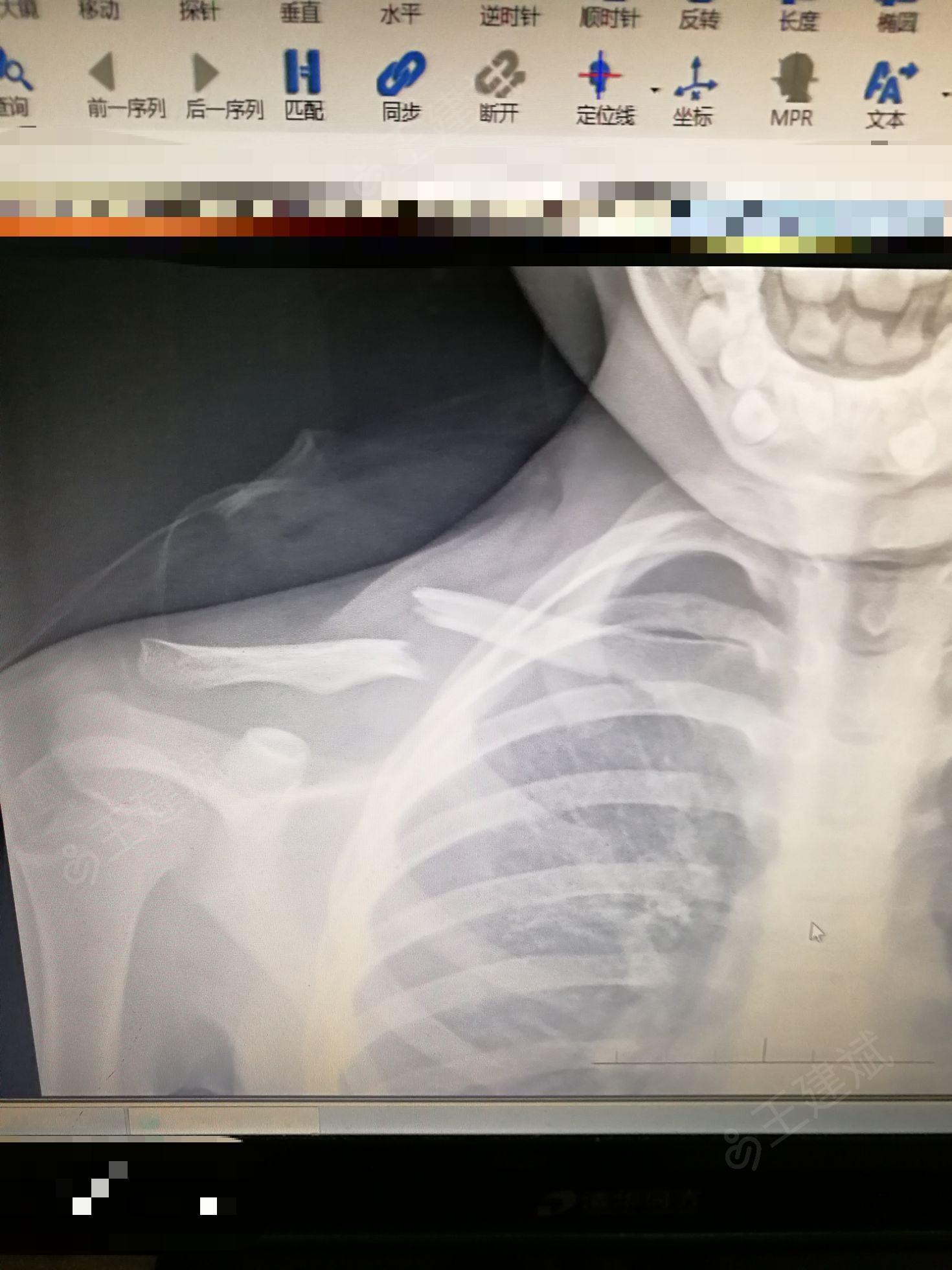 锁骨骨折x片图片