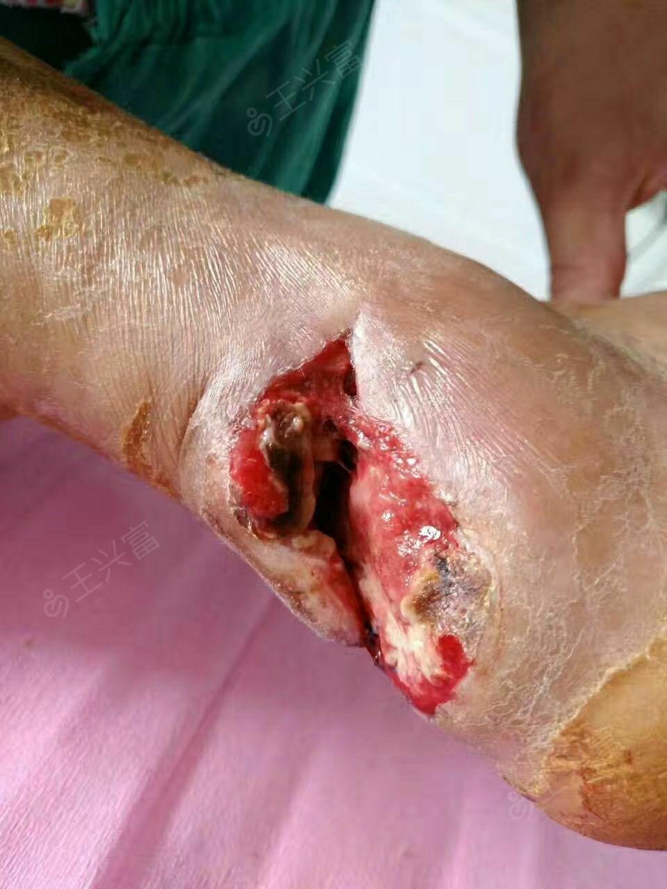 月前患者因切     跟腱开放性断裂术后感染万例挑一王兴富223患者信息