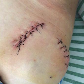 左肩锁关节脱位