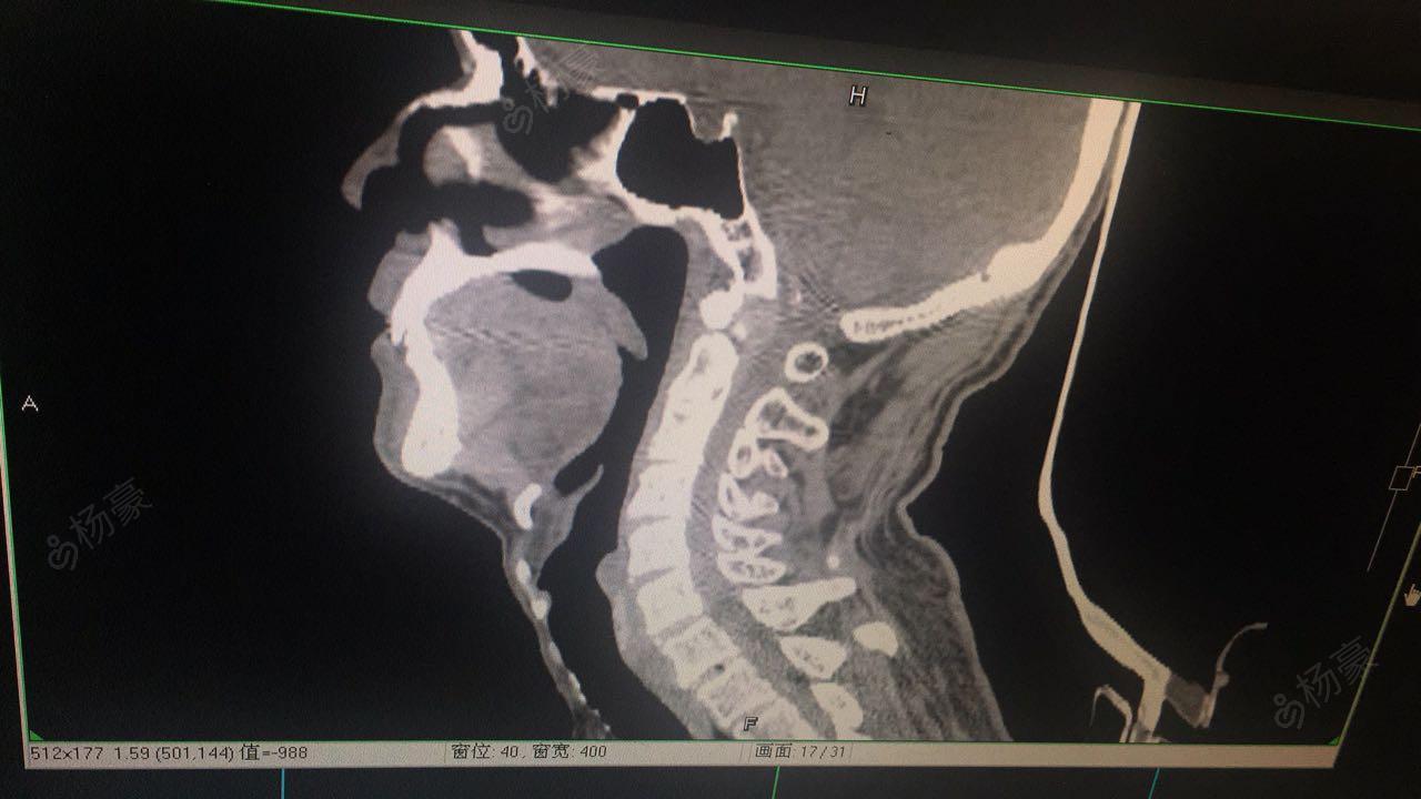 颈椎后路单开门椎管减压 微型钛板内固定术.