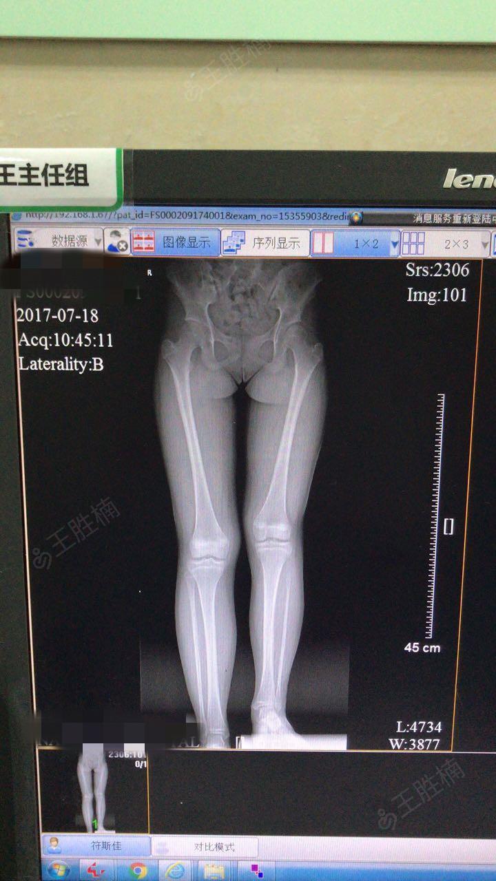 腿部正常x光照片图片