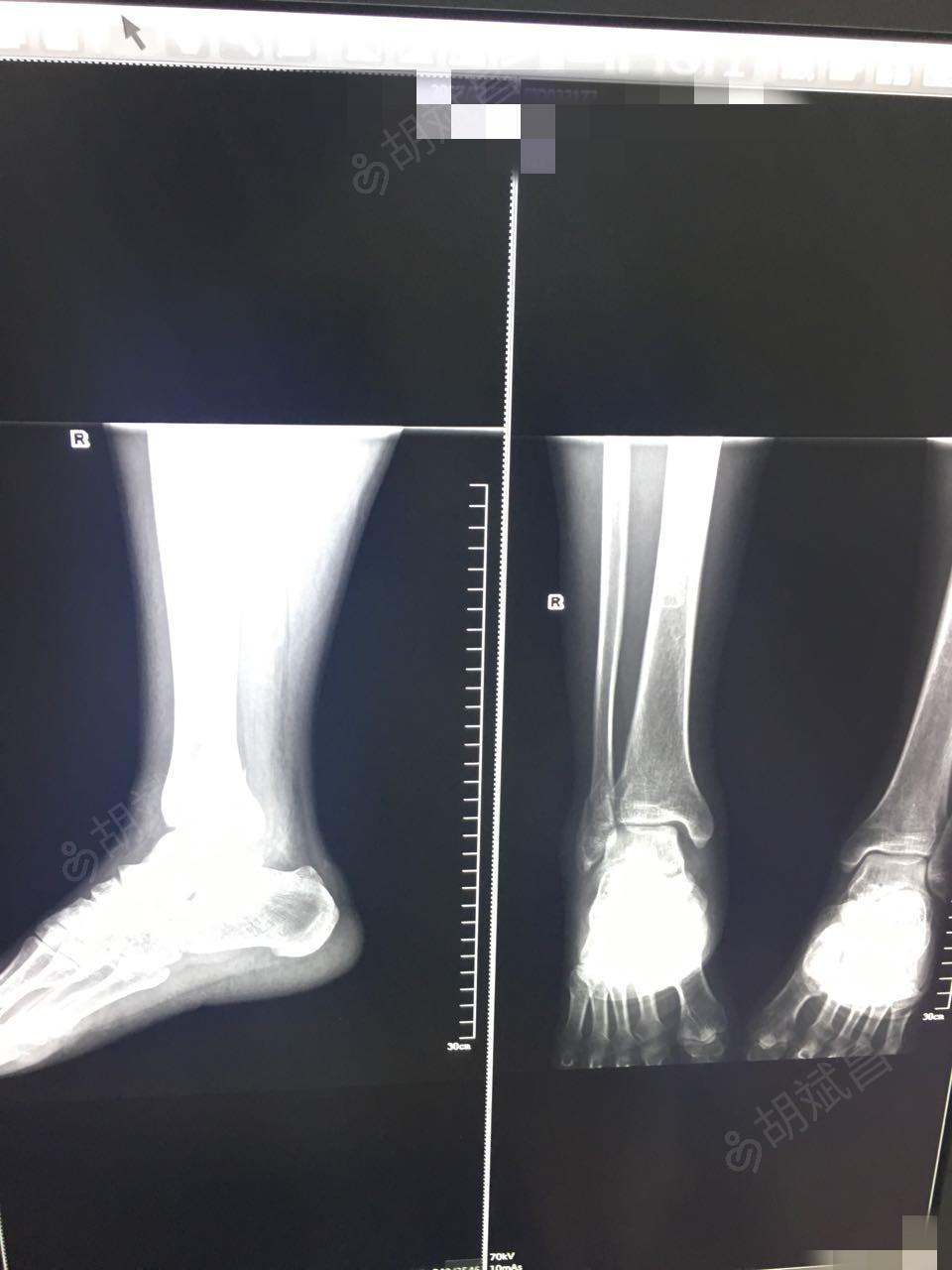 小腿骨裂图片 x光图片