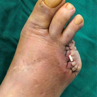 截脚趾手术步骤图图片